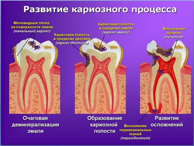 Лечение пульпита - воспаления нерва - Стоматологическая Клиника МК ДЕНТ