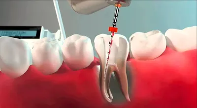 ᐉ Современные методы удаления нерва из зуба