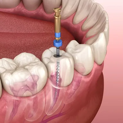 ᐉ Современные методы удаления нерва из зуба