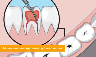 Удаление нерва зуба - цена в Нижнем Новгороде | «Даймонд-Клиник»