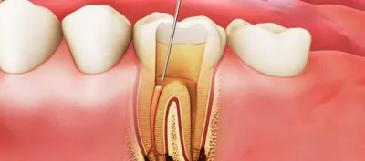 Сохранение нерва зуба | Videdent.ru