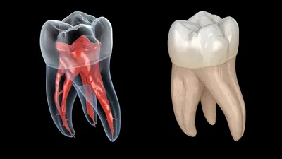 Воспаление зубного нерва - полезная информация от врачей стоматологии  доктора Фролова