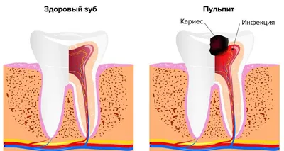 Удаление нерва зуба | Стоматология Ас-Стом | Санкт-Петербург (СПб)