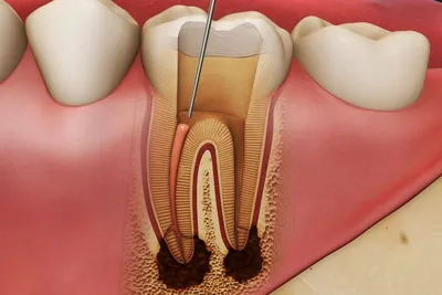 Удаление зубного нерва: показания и методики – Стоматология «АльфаДент» в  Оренбурге