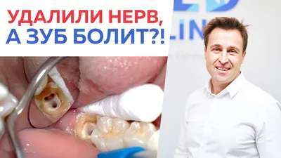 Почему болит зуб с удаленным нервом?... - Евгений Назаренко | Facebook