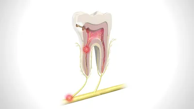Удаление нерва, чистка каналов зуба, как выглядит зубной нерв - YouTube