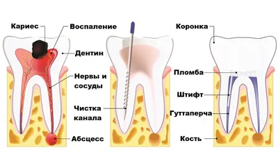 Как лечат каналы зуба? - статья от стоматологической клиники «Ионика»