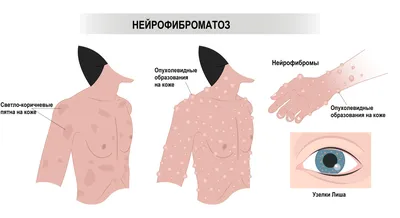 Нейрофиброматоз - причины появления, симптомы заболевания, диагностика и  способы лечения