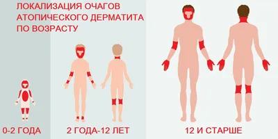 Атопический дерматит у детей: как помочь и какие препараты используют для  лечения - Здоров'я - Статьи