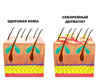 Экзема - причины и лечение в Санкт-Петербурге