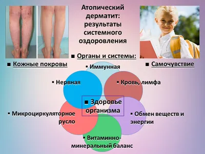 Себорея: как лечить себорею на голове