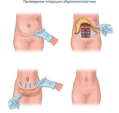 Абдоминопластика. Попытка #1. Мой опыт пластической хирургии | Отзывы  покупателей | Косметиста