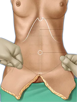 Проблемы после абдоминопластики (АРХИВ) - Страница 107 - Форум о  пластической хирургии