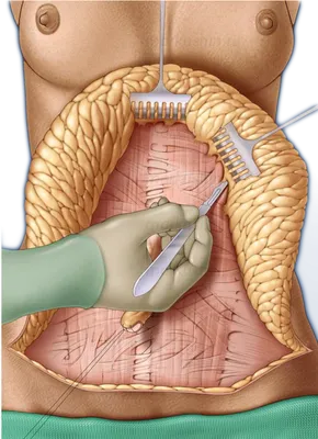 Осложнения и риски после абдоминопластики: гематомы, собачьи ушки, некроз  тканей, боли