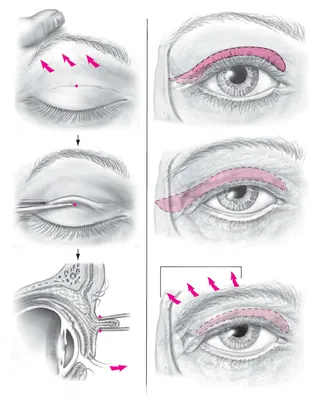 Блефаропластика ▷ Цены на блефаропластику в Киеве | Блефаропластика  верхнего и нижнего века: до и после, отзывы