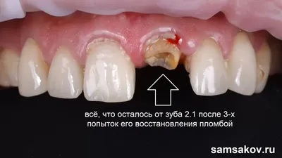 Мои зубы выпали на следующий день после имплантации. Но Bookimed помог все  исправить“: история пациента об имплантации зубов