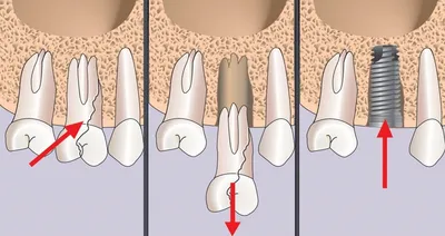 7 проблем имплантации зубов и причины неудач