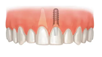 Показания и противопоказания к имплантации зубов.
