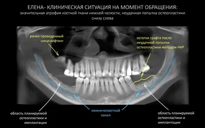 Несъемные зубные протезы