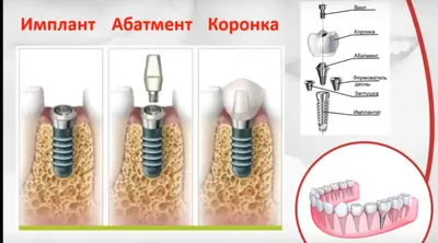 СДЕЛАНО В КЛИНИКЕ ИН: когда можно говорить о результатах остеопластики? —  CLINICIN.RU