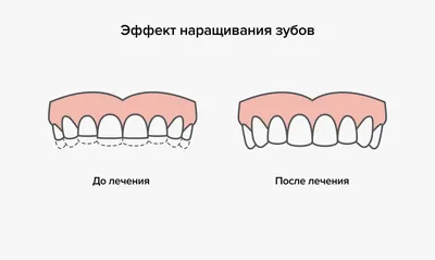 12-4-12 (имплантаты Штрауман) в СПб, цены на имплантаты Straumann