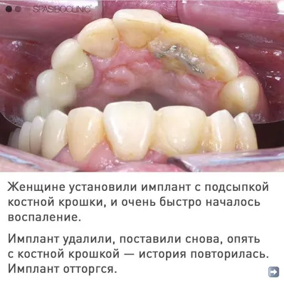 Коронки на имплант – цена на установку коронки на имплант в Москве, сколько  стоит коронка на имплант | Implant City