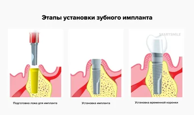 Скуловые импланты Zygoma