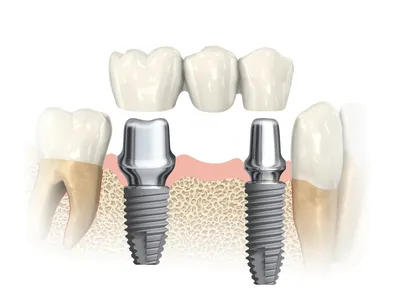Имплантация зубов — этапы, виды, фото, как делают операцию по установке  зубного импланта?