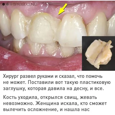 сделано в CLINIC IN: РЕСТАВРАЦИЯ РЕЗЦОВ ВЕРХНЕЙ ЧЕЛЮСТИ — IMPLANT-IN.COM —  дентальная имплантация. естественно.