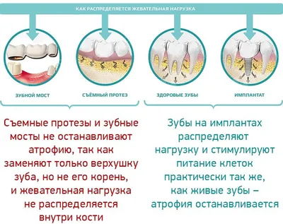 Скол винира на переднем зубе