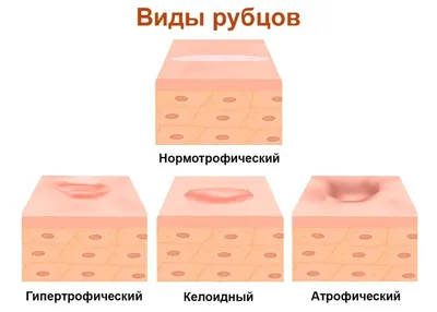 Лабиопластика – быстрая и полезная операция для женщин