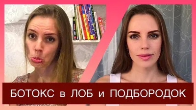 Инъекции ботокса - «⁉️ Ботокс - самый известный ботулотоксин. Лоб,  межбровье, жевательные мышцы и уголки рта. Зачем я делаю ЭТО уже около  десяти лет. » | отзывы