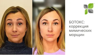 Ботокс в лоб в салоне Эл. Эн. Beauty Club на станции метро Сходненская