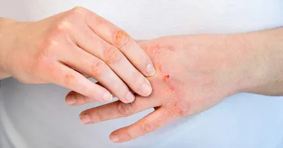 Что такое кожный дерматит и как его лечить?. Сеть медицинских центров и МЦ  «Здоровье» в Москве.