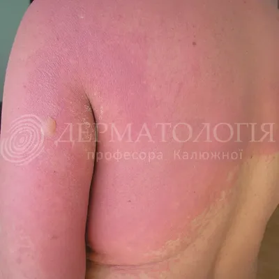 Аллергический дерматит консультация лечение в Санкт-Петербурге в  медицинском центре ID-CLINIC
