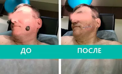 Laser Medical - ВНУТРИДЕРМАЛЬНЫЙ НЕВУС ✔️На фото - внутридермальный невус  или, как его еще называют - родинка.⠀ ✔️Невус, помимо эстетического  дискомфорта, также доставлял и неудобства пациентке. Он мешал ей носить  очки, часто