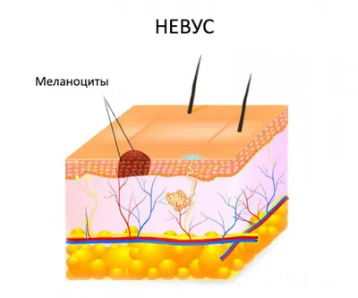 Папилломатозный невус - признаки, причины, симптомы, лечение и профилактика  - iDoctor.kz