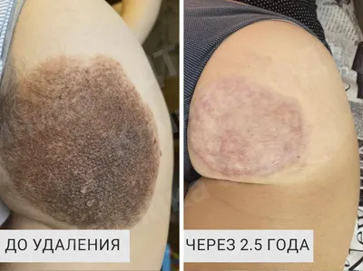 Синдром атипичного невуса - Premium Aesthetics