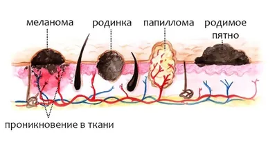 Удаление родинок в Минске лазером - Удаление невусов