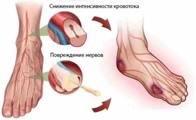 Какие могут быть осложнения при лечении диабетических язв? ✓ Авторские  статьи Клиники подологии Полёт