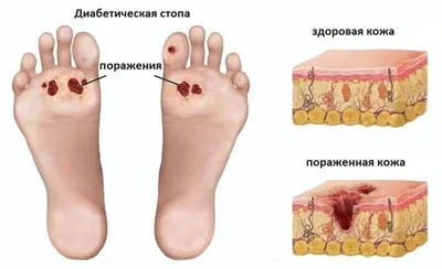 Синдром диабетической стопы - СПАСЕНИЕ ЕСТЬ | Medical Plaza