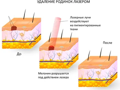 Родинки: почему появляются и что с ними делать? - Euromed