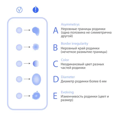 16 симптомов меланомы: что делать если нашли один?