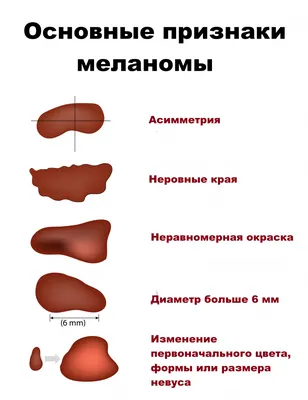 Что такое невусы (родинки) и их разновидности - Лазерсвiт