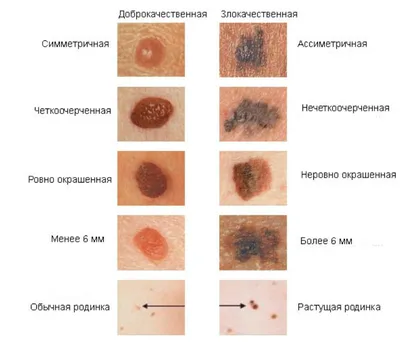 Родинки: почему появляются и что с ними делать? - Euromed