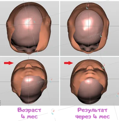 Деформация головы у ребенка - Ортотис Премиум
