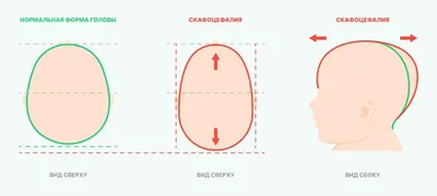 Скафоцефалия: что это такое? — Медицинский центр «Целитель»