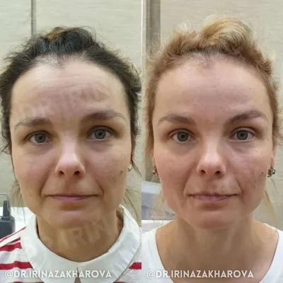 Биоревитализация в клинике Health Face