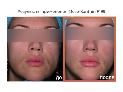 Биоревитализация Profhilo (Профайло): отзывы и фото \"до\" и \"после\" | Beauty  Insider