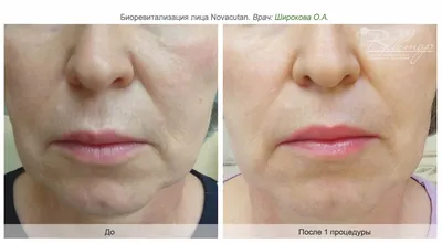 Beauty Clinic Bryusov - Novacutan (Новакутан) – инновационный  препарат-экзопротектор, направленный на борьбу с различными видами старения  кожи. Биоревитализант Новокутан является наиболее эффективной  разновидностью современной инъекционной косметологии ...